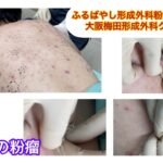 背部の多発性の粉瘤　ブログでも粉瘤について詳しく解説してます。ふるばやし形成外科粉瘤クリニック東京新宿院　大阪梅田形成外科クリニック