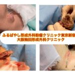 頚部　首の粉瘤　４cm大　ブログで解説入れてます。ふるばやし形成外科粉瘤クリニック東京新宿院　大阪梅田形成外科クリニック