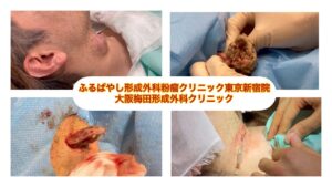 頚部　首の粉瘤　４cm大　ブログで解説入れてます。ふるばやし形成外科粉瘤クリニック東京新宿院　大阪梅田形成外科クリニック