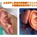 耳の大きなケロイド　ブログでケロイドとオペについて詳しく解説してます。ふるばやし形成外科粉瘤クリニック東京新宿院　大阪梅田形成外科クリニック