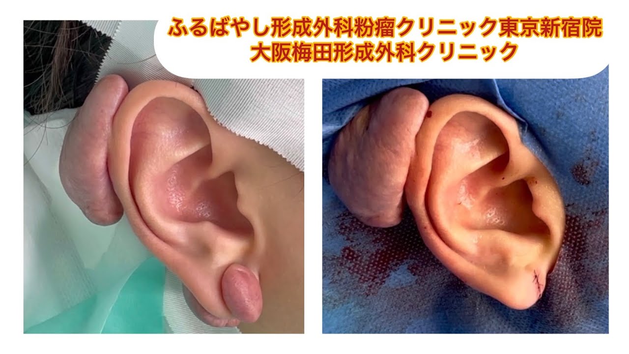 耳の大きなケロイド　ブログでケロイドとオペについて詳しく解説してます。ふるばやし形成外科粉瘤クリニック東京新宿院　大阪梅田形成外科クリニック