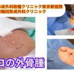 オデコの外骨腫　ブログでも外骨腫について詳しく解説してます。　ふるばやし形成外科粉瘤クリニック東京新宿院　大阪梅田形成外科クリニック