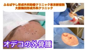 オデコの外骨腫　ブログでも外骨腫について詳しく解説してます。　ふるばやし形成外科粉瘤クリニック東京新宿院　大阪梅田形成外科クリニック