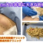 大腿部の非常に大きな粉瘤　ブログでも粉瘤について詳しく解説してます。ふるばやし形成外科粉瘤クリニック東京新宿院　大阪梅田形成外科クリニック