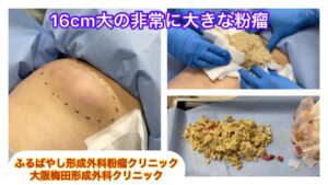 大腿部の非常に大きな粉瘤　ブログでも粉瘤について詳しく解説してます。ふるばやし形成外科粉瘤クリニック東京新宿院　大阪梅田形成外科クリニック