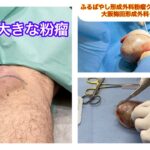 膝裏の大きな粉瘤 ブログでも粉瘤について詳しく解説してます。ふるばやし形成外科粉瘤クリニック東京新宿院 大阪梅田形成外科クリニック