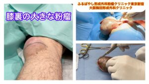 膝裏の大きな粉瘤　ブログでも粉瘤について詳しく解説してます。ふるばやし形成外科粉瘤クリニック東京新宿院　大阪梅田形成外科クリニック
