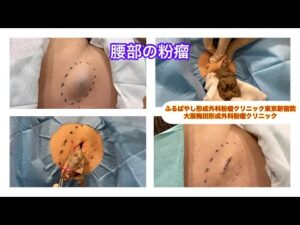 腰の5cm大の粉瘤　ブログで症例について詳しく解説してます。ふるばやし形成外科粉瘤クリニック東京新宿院　大阪梅田形成外科クリニック