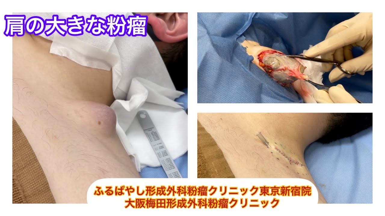 肩の１０cmの粉瘤　ブログで、この症例について詳しく解説してます。ふるばやし形成外科粉瘤クリニック東京新宿院　大阪梅田形成外科クリニック