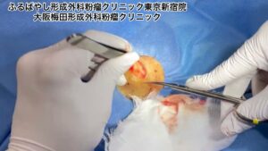 首の脂肪腫　ブログでも今回の脂肪腫について詳しく解説してます。ふるばやし形成外科粉瘤クリニック東京新宿院　大阪梅田形成外科クリニック