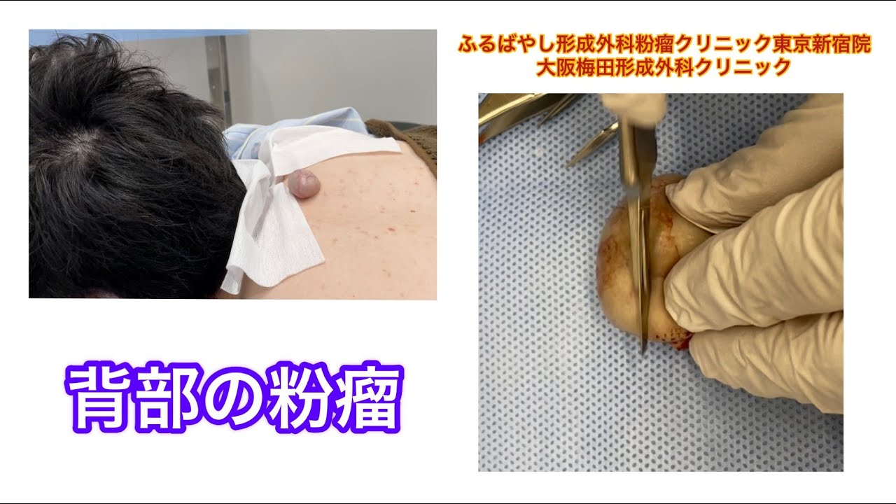 背部の切らざるおえない粉瘤　ブログでも粉瘤について詳しく解説してます。ふるばやし形成外科粉瘤クリニック東京新宿院　大阪梅田形成外科クリニック