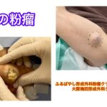 腕の粉瘤　ブログでも粉瘤について詳しく解説してます。ふるばやし形成外科粉瘤クリニック東京新宿院　大阪梅田形成外科クリニック
