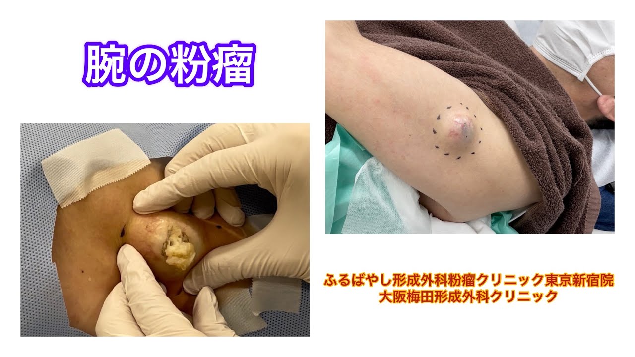 腕の粉瘤　ブログでも粉瘤について詳しく解説してます。ふるばやし形成外科粉瘤クリニック東京新宿院　大阪梅田形成外科クリニック