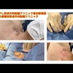 頚部の粉瘤　ブログでも粉瘤について詳しく解説してます。ふるばやし形成外科粉瘤クリニック東京新宿院　大阪梅田形成外科クリニック