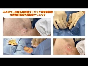 頚部の粉瘤　ブログでも粉瘤について詳しく解説してます。ふるばやし形成外科粉瘤クリニック東京新宿院　大阪梅田形成外科クリニック