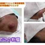 オデコの粉瘤　ブログでも粉瘤について詳しく解説してます。ふるばやし形成外科粉瘤クリニック東京新宿院　大阪梅田形成外科クリニック