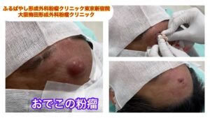 オデコの粉瘤　ブログでも粉瘤について詳しく解説してます。ふるばやし形成外科粉瘤クリニック東京新宿院　大阪梅田形成外科クリニック