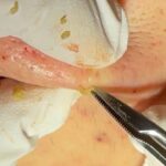 角栓除去　blackhead  ニキビ　ブログでも詳しく解説してます。　ふるばやし形成外科粉瘤クリニック東京新宿院　大阪梅田形成外科クリニック