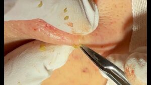 角栓除去　blackhead  ニキビ　ブログでも詳しく解説してます。　ふるばやし形成外科粉瘤クリニック東京新宿院　大阪梅田形成外科クリニック