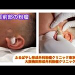 耳前部の粉瘤　ブログでも粉瘤について詳しく解説してます。ふるばやし形成外科粉瘤クリニック東京新宿院　大阪梅田形成外科クリニック