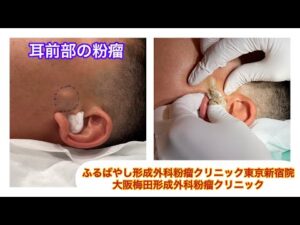 耳前部の粉瘤　ブログでも粉瘤について詳しく解説してます。ふるばやし形成外科粉瘤クリニック東京新宿院　大阪梅田形成外科クリニック