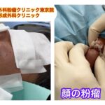 顔の粉瘤　 ブログでも詳しく解説してます。　ふるばやし形成外科粉瘤クリニック東京新宿院　大阪梅田形成外科クリニック