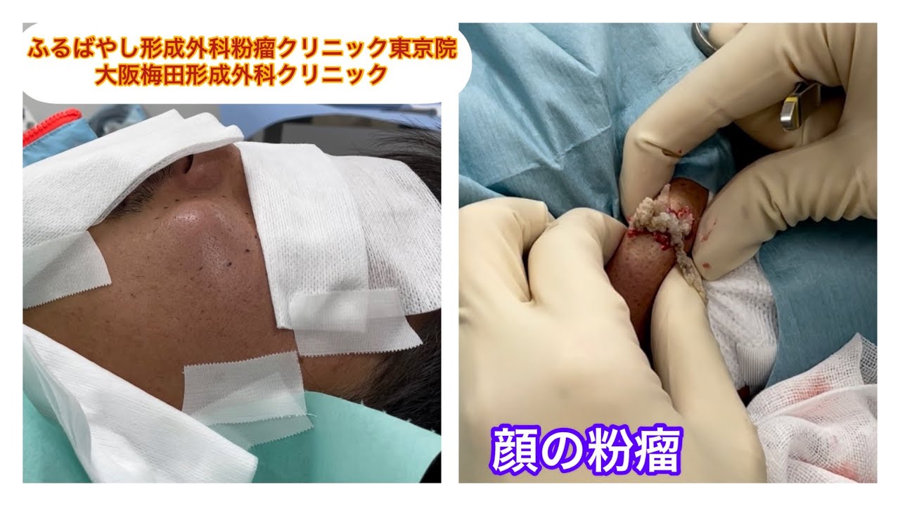 顔の粉瘤　 ブログでも詳しく解説してます。　ふるばやし形成外科粉瘤クリニック東京新宿院　大阪梅田形成外科クリニック