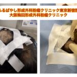 頭部の粉瘤とイボ除去　　ブログでも詳しく解説してます。　ふるばやし形成外科粉瘤クリニック東京新宿院　大阪梅田形成外科クリニック
