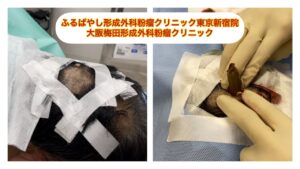 頭部の粉瘤とイボ除去　　ブログでも詳しく解説してます。　ふるばやし形成外科粉瘤クリニック東京新宿院　大阪梅田形成外科クリニック