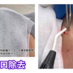 ほくろの除去　焼灼による除去　ブログでも詳しく解説してます。　ふるばやし形成外科粉瘤クリニック東京新宿院　大阪梅田形成外科クリニック