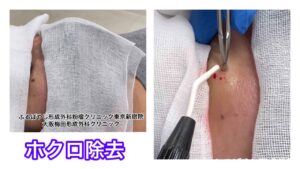 ほくろの除去　焼灼による除去　ブログでも詳しく解説してます。　ふるばやし形成外科粉瘤クリニック東京新宿院　大阪梅田形成外科クリニック