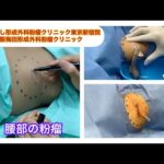 腰の粉瘤　　ブログでも粉瘤について詳しく解説してます。ふるばやし形成外科粉瘤クリニック東京新宿院　大阪梅田形成外科クリニック