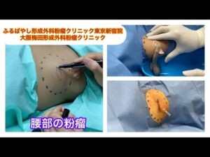 腰の粉瘤　　ブログでも粉瘤について詳しく解説してます。ふるばやし形成外科粉瘤クリニック東京新宿院　大阪梅田形成外科クリニック