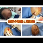 頭部の感染した粉瘤と脂肪腫　ブログでも粉瘤について詳しく解説してます。ふるばやし形成外科粉瘤クリニック東京新宿院　大阪梅田形成外科クリニック