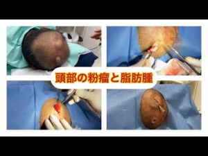 頭部の感染した粉瘤と脂肪腫　ブログでも粉瘤について詳しく解説してます。ふるばやし形成外科粉瘤クリニック東京新宿院　大阪梅田形成外科クリニック